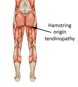 Tight/Sore Hamstrings Benefit With Chiropractic Manipulation